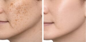 Read more about the article Pigmentation Problems Explained: When Skincare Is Not Enough